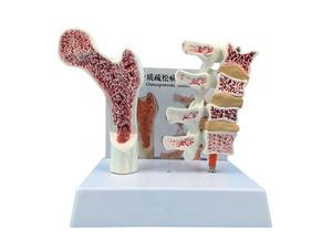 แบบจำลองพยาธิวิทยาโรคกระดูกพรุน แบบจำลองกระดูกต้นขาและกระดูกสันหลังส่วนเอว แบบจำลองพยาธิวิทยาโรคกระดูกเสื่อม 4 ขั้นตอน - Product Image 5