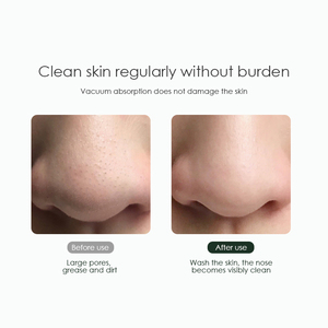 KSKIN KD802P - Removedor Eléctrico de Puntos Negros, Limpiador de Poros al Vacío, 3 Niveles de Succión, 4 Cabezales, Ampliación HD 10x, Uso Manual en el Rostro - Product Image 4