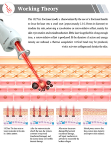 Dispositivo Láser de Cuidado de la Piel de 1927nm, Popular en 2026, con Material ABS, Reduce las Líneas Finas y las Arrugas, para Uso en Spa - Product Image 3