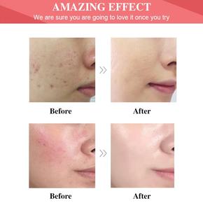 Produits de soin du <span class=keywords><strong>visage</strong></span> coréens, soins professionnels de la peau, hydratant, acide salicylique, kit d'élimination des boutons, ensemble de soins de la peau pour femmes noires - Product Image 2