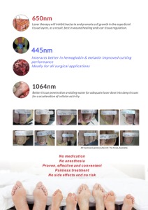 Láser onicomicosis Podology luz halógena hongos en las uñas 1470nm 980 diodo hongos en las uñas mango de Podología dispositivo quirúrgico para el cuidado de los pies - Product Image 6