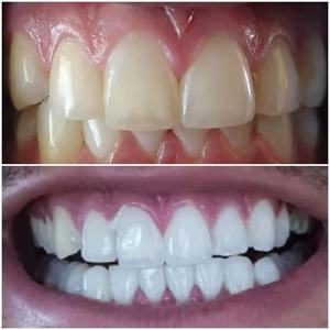 Kit Sbiancante per Denti Ricaricabile Wireless RIJIE <span class=keywords><strong>SMILE</strong></span> per Uso Domestico Sicuro, 32 Luci LED Blu e Rosse, Penna Gel Senza Perossido, Portatile e di Lusso - Product Image 3