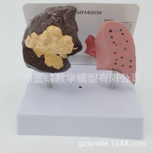Modelo de pulmón, molde de la estructura pulmonar, riesgos para la salud por el tabaquismo, sistema respiratorio pulmonar del fumador, modelo anatómico patológico del pulmón - Product Image 4