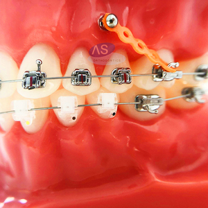 Micro impianto ortodontico <span class=keywords><strong>Mini</strong></span> viti accessori impianto dentale endosseo - Product Image 3