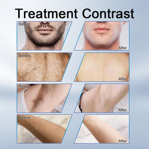 Certificats complets 808nm Diode <span class=keywords><strong>Laser</strong></span> 3 vagues 755 808 1064 Machine d'épilation au <span class=keywords><strong>laser</strong></span> clinique à longue impulsion - Product Image 6