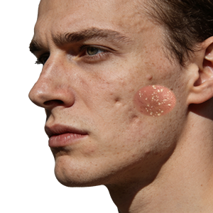 <span class=keywords><strong>Peeling</strong></span> <span class=keywords><strong>Químico</strong></span> Profesional con Ácido Blanco al 70% para Cicatrices, Eliminación de Acné y Exfoliación Profunda de la Piel del Rostro - Product Image 4