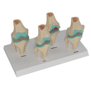 Modèle d'articulation du genou en science médicale, ensemble d'arthrose à 4 étapes, articulation du genou pour le bureau des médecins, outil éducatif - Product Image 3