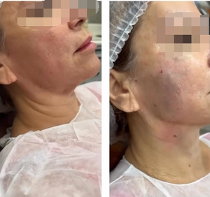 医療規格60Wレーザーブラントカニュラニードル980nm 1470nmエンドリフティングダイオード脂肪吸引用美容機器 - Product Image 3