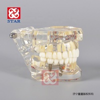 Modelo de estudio dental modelo de demostración clínica mplant todo en un modelo con nervio