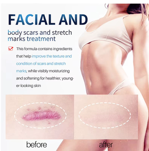Crème de blanchiment corporel OEM en gros, puissante et efficace pour l'élimination des cicatrices d'acné, des boutons, des vergetures, des genoux foncés, des coudes, des doigts - Product Image 5