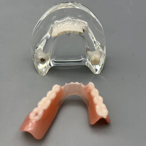 แบบจำลองการใส่รากฟันเทียมแบบถอดได้สำหรับการสาธิตทางทันตกรรมและการสื่อสารกับผู้ป่วย - Product Image 2