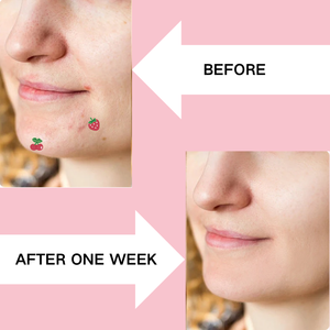 Plester Hidrokoloid Penutup Jerawat Wajah Grosir, Pembersih Pori, Perawatan Noda Wajah, Semua Jenis Kulit, Vegan, Minyak Tea Tree - Product Image 4