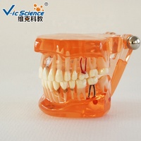 Restauration avec implant modèle de dents dentaires modèle d'enseignement des sciences médicales modèle de dents humaines