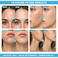 Gel personnalisable pour cicatrices d'acné à l'acide salicylique, cellules souches de saumon, acide hyaluronique, centella, minimiseur de pores, nourrissant, éclaircissant, OEM