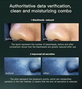 Thẩm mỹ viện nhỏ bong bóng oxy tiêm cụ Hydra dermabrasion máy mặt làm sạch sâu Peel mụn đầu đen hấp thụ - Product Image 4