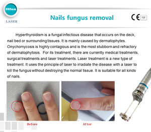 Dispositivo 6 <span class=keywords><strong>en</strong></span> 1 para Eliminación de Hongos <span class=keywords><strong>en</strong></span> las Uñas (Onicomicosis), Podología, Eliminación Vascular de Venas 980, Exfoliación y Rejuvenecimiento - Product Image 4