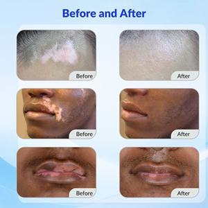 Láser LED Excimer UVB Portátil de 308 nm para Vitiligo, Psoriasis, Dermatitis Atópica, Eccema, Dermatitis Seborreica en Venta - Product Image 3