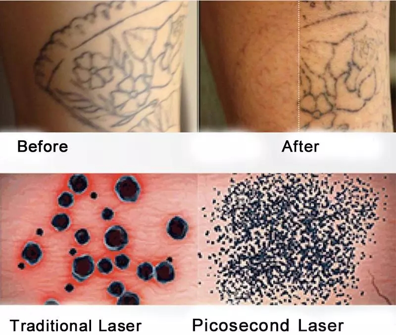 Stand 2 in 808nm diode hair removal and nd yag laser tattoo removal machine