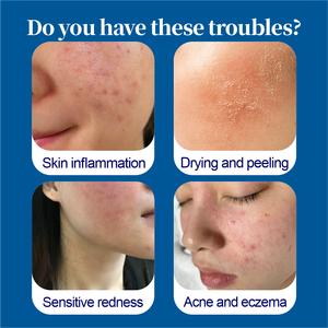 Crema per la Cura della Pelle, Unguento per Psoriasi, Crema Trattamento a Base di Erbe, Crema Riparatrice per la Pelle - Product Image 2