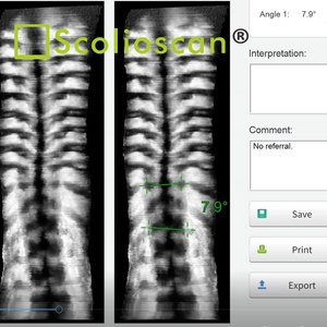 Escáner 3D de ultrasonido para medición de escoliosis en servicios de fisioterapia - Product Image 6
