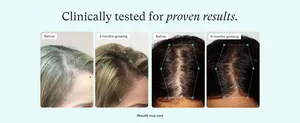 6 יחידות 60 מ""ל טיפול טיפוח שיער 5% צמיחת שיער סוכן שמן מונע קרק קרקע נשירת שיער סרום צמיחה מזין