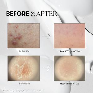 VT COSMETICS Reedle Shot Compact Set 10ml 3 Pezzi Siero Microneedling Esfoliante Anti-Età per la Cura del Viso - Product Image 3