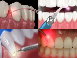 Máquina Láser Diodo Dental Portátil de 980nm para Blanqueamiento Dental con Láser de Tejido Blando - Product Image 4