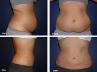Appareil de remodelage corporel et d'amincissement par lipolyse endolaser Fiberlift 980nm1470nm et liposuccion Vaser