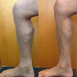 מכשיר לייזר ליפאו אנדל לייזר מכשיר לייזר ליפן 980nm ו 1470nm דיודה לייזר פלזמה עבור jawline & צוואר הידוק מסכת המסת שומן - Product Image 6