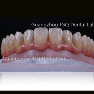 Support d'implant Restaurations dentaires Pont <span class=keywords><strong>en</strong></span> <span class=keywords><strong>zircone</strong></span> vissé avec barre <span class=keywords><strong>en</strong></span> titane Laboratoire <span class=keywords><strong>dentaire</strong></span> chinois - Product Image 3