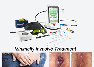 Laser Chirurgico Berylas 1470nm 12W Alimentato Elettricamente Certificato CE ISO Classe III per Proctologia Emorroidi Diode Laser per Fistole e Fissure - Product Image 3