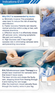 Eliminador de <span class=keywords><strong>Venas</strong></span> Varicosas, Láser Diodo EVLT, Fibra EVLA de 600 micras, Fibra Radial, Endoláser Vascular - Product Image 4