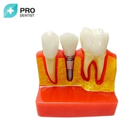 Modèle dentaire, Implants dentaires de modèle d'implant, Modèle dentaire de pont de couronne,