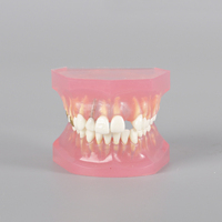 Modelo de Tratamiento de Caries con Puente de Caries e Implante