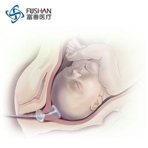 Attrezzatura Ostetrica e Ginecologica Monouso di Classe II, Palloncino per Maturazione Cervicale con Stiletto 80ml CE, Doppio/Triplo Lume, Sterilizzato con EO - Product Image 3