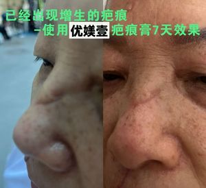 Crema Reparadora de Cicatrices con Fórmula Personalizada de Vidrio Bioactivo, Tratamiento para Marcas de Estrías del Embarazo, 20g, Cicatrices de Cesárea - Product Image 6