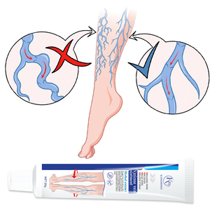 <span class=keywords><strong>Precio</strong></span> de fábrica Crema para aliviar el dolor 20g Crema para <span class=keywords><strong>venas</strong></span> varicosas - Product Image 2