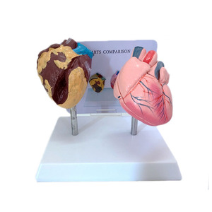 Modelo Anatómico Educativo Médico para Comparación de Corazones Saludables y Dañados por el Tabaco, de PVC, Pintado a Mano y Elaboradamente Tallado - Product Image 1