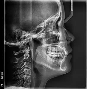 Kullanılmış Vatech PaX-i3D 3D Tanı Panoramik Diş Röntgeni 3'ü 1 Arada Pano CBCT Ceph Dijital Opg Cihazı - Product Image 3