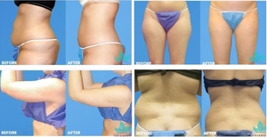 Máquina de Liposucción Láser de Diodo <span class=keywords><strong>980</strong></span>+1470nm, Modelo 2026, para Eliminación de Papada y Lifting Facial con Endoláser - Product Image 5
