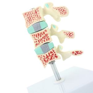 Osteoporose-Knochen modell-Zeigen Sie die normale/Osteopenie/osteoporo tische Knochen dichte mit abnehmbarem Wirbel - Product Image 3