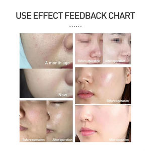 Équipement de salon de beauté à eau légère, nettoyage en profondeur par jet d'eau à haute pression non invasif, resserrement de la peau, rajeunissement de la peau - Product Image 5