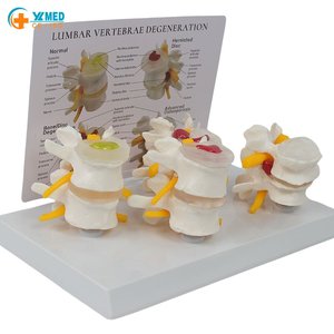 Model Perbandingan Tulang Belakang Lumbar Patologis 4 Tahap Bersertifikasi CE/ISO, Model Tulang Belakang Manusia Profesional untuk Pelatihan Medis - Product Image 1