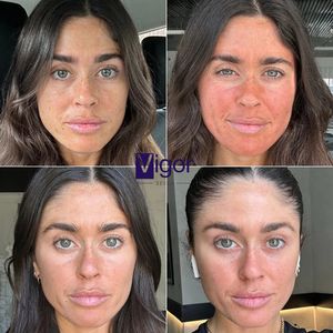 Vente chaude Mesoestetic Sun Protective Bâton Réparateur <span class=keywords><strong>Cosmelan</strong></span> Peel Set Kit <span class=keywords><strong>Cosmelan</strong></span> - Product Image 6