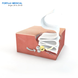 Rotoli di Medicazione in Alginato 10cm X 20cm |   Fibra Naturale di Alghe per Ulcere da Pressione e Cura del Piede Diabetico - Product Image 6