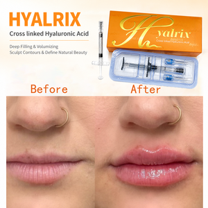 Hyalrix Relleno Dérmico <span class=keywords><strong>Inyectable</strong></span> de Ácido Hialurónico de Grado Médico <span class=keywords><strong>para</strong></span> Relleno de <span class=keywords><strong>Labios</strong></span>, Eliminación de Arrugas y Tratamiento de Belleza - Product Image 3