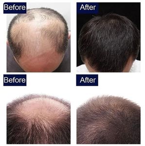 Minyak penumbuh rambut cepat 7 hari, produk kecantikan Serum perawatan kulit kepala pria wanita rontok Anti rambut - Product Image 3