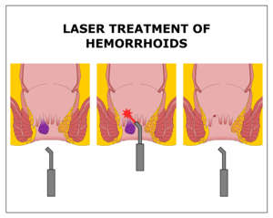 Laser de diodo para hemorróidas colorretal de 60 watts 980nm para hemorróidas, produto alemão minimamente invasivo - Product Image 5
