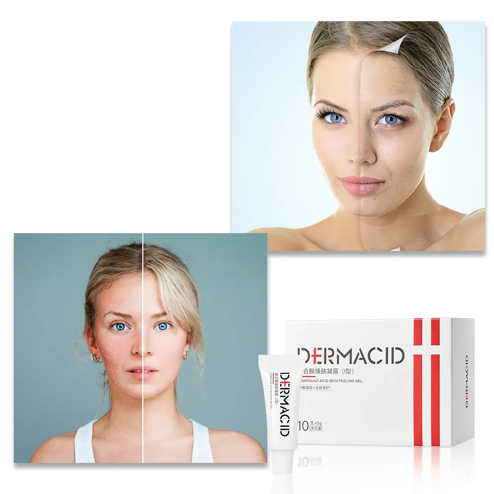 JUYOU Best Seller Beauty Salon Used Professional Face Skincare Chemical Peeling Gel For Anti Acne Pigmentation