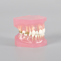 Modelo de Tratamiento de Caries con Puente de Caries e Implante